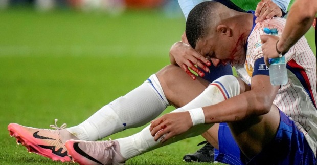 Mbappe sitzt am Rasen, den Kopf zwischen den Beinen und die Nase haltend. Er blutet. Helfer reichen ihm Wasser.
